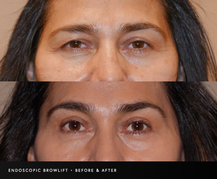 Endoscopic Browlift Before and After