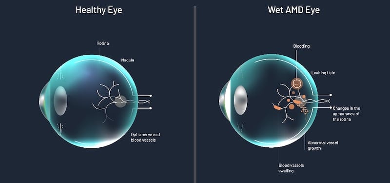 Groundbreaking Eye Procedure for Treating Wet AMD