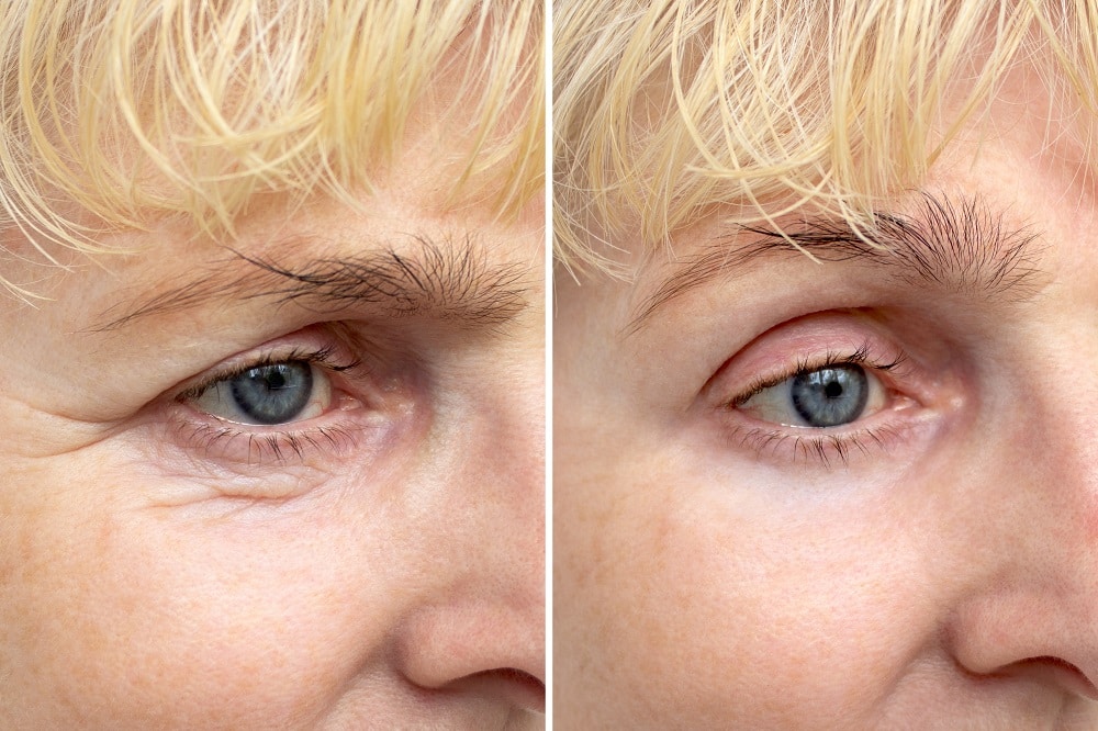 Before and after of a blepharoplasty patient.