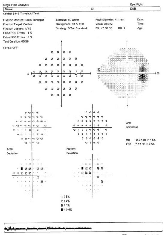 understanding-glaucoma-test-results-what-do-they-mean